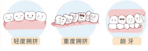 窝沟封闭小孩子都需要做吗,牙齿窝沟封闭的缺点